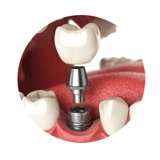 Denizli implant